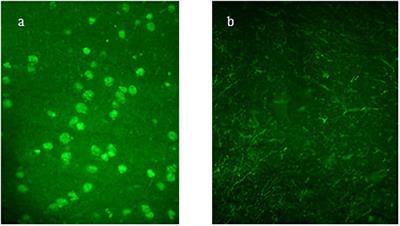 Antibodies Against Hypothalamus and Pituitary Gland in Childhood-Onset Brain Tumors and Pituitary Dysfunction